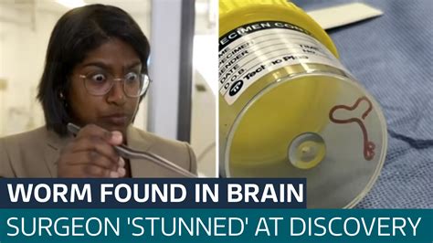 Surgeon Felt A Bit Sick After Plucking Wriggling Worm From Woman S Brain In Australia Latest