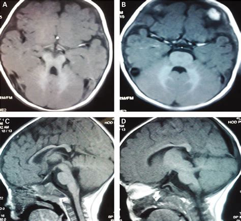 Joubert Syndrome Type I Neuroimaging Findings In Addition
