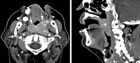 Contrast Enhanced Ct Images In A Patient With Soft Palate Cancer A