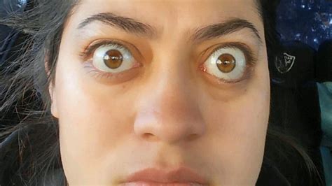A Woman With Bulging Eyes From Graves Disease Undergoes A Remarkable