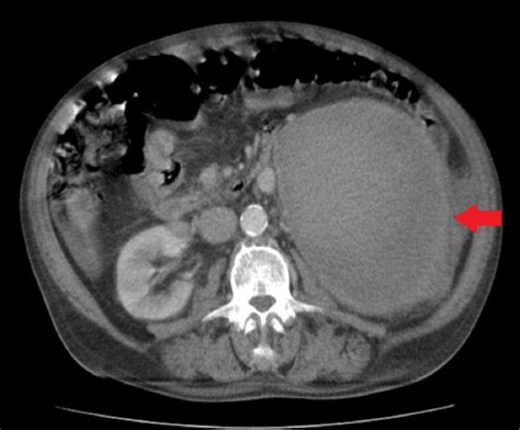 Retroperitoneal Bleed Ct Scan