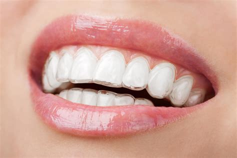 Where To Find Invisalign Dental Treatment Central