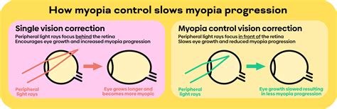 How Do Myopia Control Soft Contact Lenses Work My Kids Vision