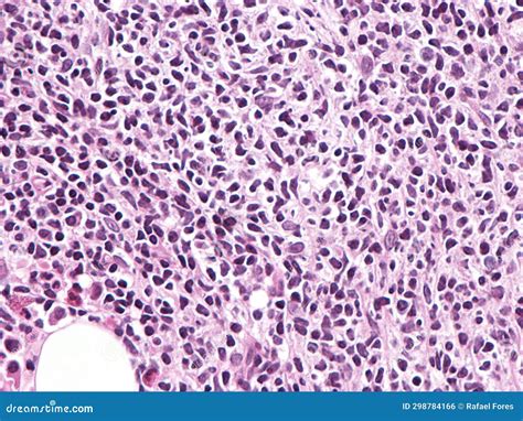 Follicular Lymphoma In Bone Marrow Stock Photo Image Of Clinical