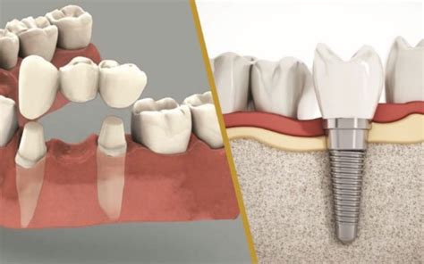 So Sánh Bọc Răng Sứ Và Trồng Răng Implant Khác Nhau Như Thế Nào Nha Khoa Lê Đông