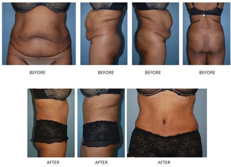 You will be under general anesthesia during the surgery. Tummy Tuck Nyc | Tummy Tuck Specialist | Tummy Tuck ...