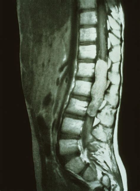 Spinal Cord Cancer Mri Photograph By Mehau Kulyk