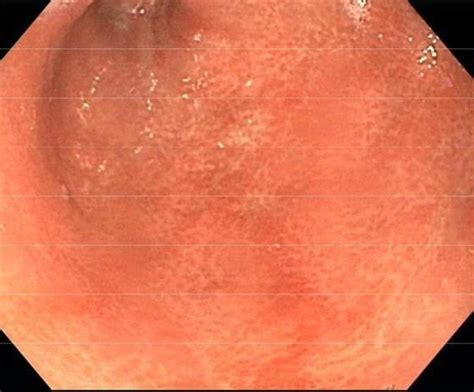 Esophagogastroduodenoscopy Demonstrating Gastric Mucosa With Mild