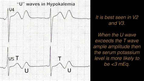Hypokalemia What Are The Ekg Changes Associated With It Youtube