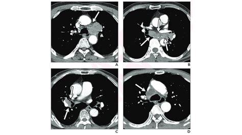 Andrew Rosenkrantz On Twitter New Ajrradiology Accepted Manuscript