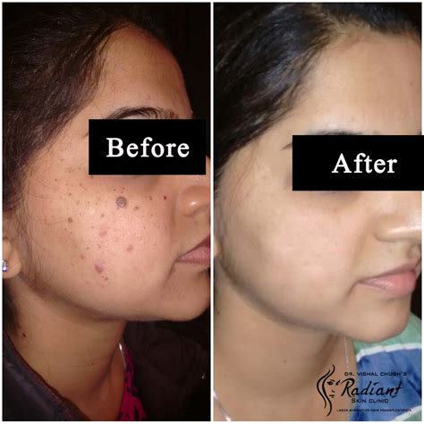 Best Acne Treatment In Jaipur I Dr Vishal Chugh I Radiant Skin Clinic