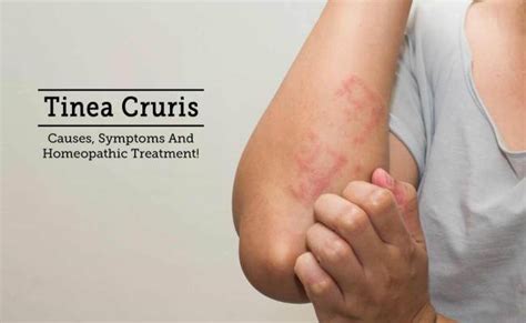 Jock Itch Tinea Cruris Causes Symptoms And Treatment Otosection
