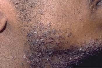 Facial bumps with ingrown hairs are usually painful and can irritate your skin too particularly when you touch or try to pop them now and then. Black men and razor bumps - 50BOLD