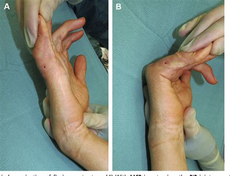 Figure 2 From Postburn Contractures Of The Hand Semantic Scholar