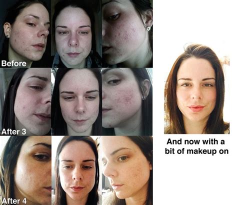 Skinbase Ipl Acne Treatments Before And After 4 Treatments Ipl
