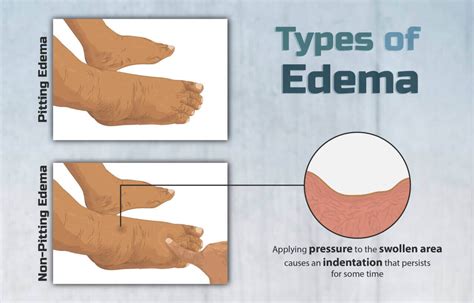 What Is Edema 6 Types Symptoms And Causes 2024