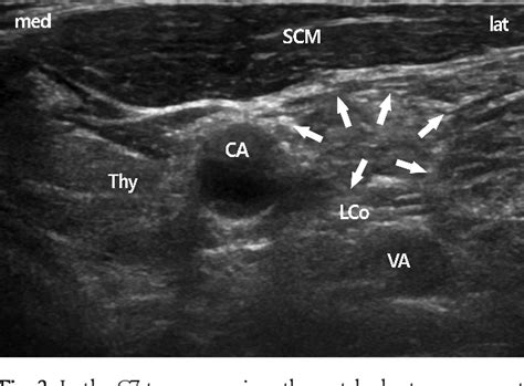 Figure 2 From Comparison Of Ultrasound Guided Stellate Ganglion Block