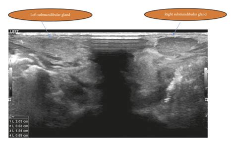 Ultrasound With Bilateral Submandibular Gland Enlargement Hypoechoic