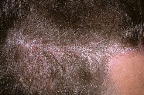 Psoriasis Scalp Photo Skin Disease Pictures