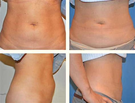 Mrudangi thakur plastic & reconstructive surgery is partnered with care credit® to bring patients an easy, affordable payment solution. Liposuction | Pioneer Valley Plastic Surgery, Springfield, MA