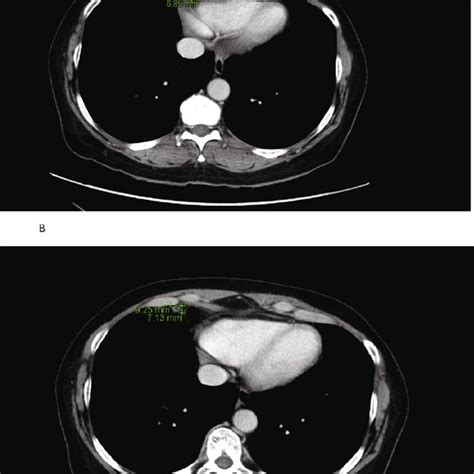 Preoperative Ct Scan Showing Enlarged Supradiaphragmatic Lymph Nodes