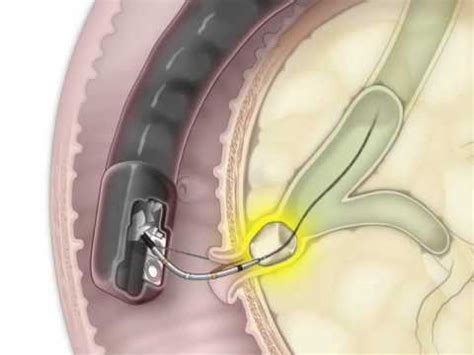 Maybe you would like to learn more about one of these? ERCP for Removal of a Stone in the Bile Duct - YouTube