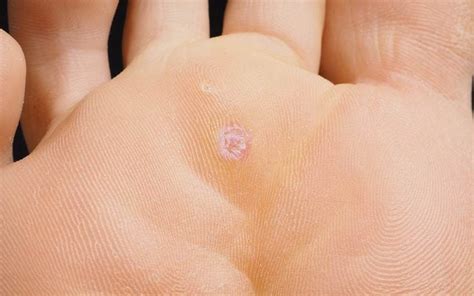 Plantar Wart Removal How To Remove Warts With Duct Tape The Healthy