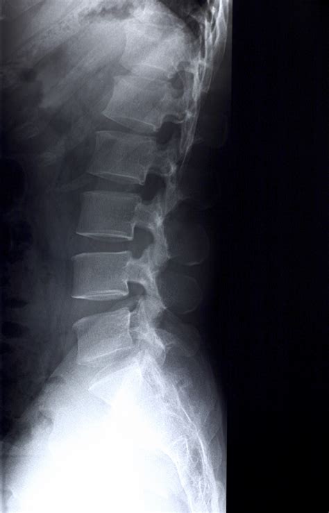Normal lumbar lordosis measurement, the retrospective approach is a credible alternative to. X-rays | National Institute of Biomedical Imaging and ...
