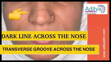 Dark Line Across The Nose Pigmentation On Nose Transverse Nesal
