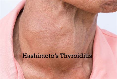 Hashimotos Thyroiditis