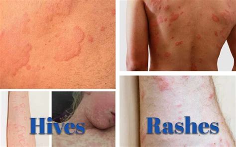 Rash Vs Hives How To Identify And Treat Them Naturally