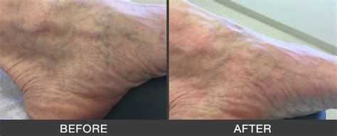 What Are Varicose Veins Vein Care Center Of Amelia Island
