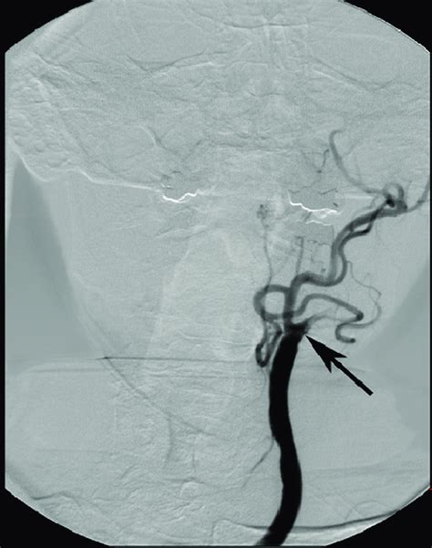 Internal Carotid Artery Occlusion Frontal Projection From Left