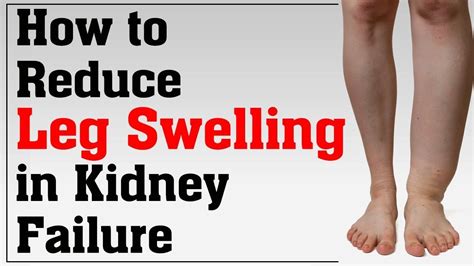 Kidney Failure Leg Swelling Kidkads