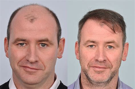 Are The Results Of Hair Transplant Permanent Conflict News
