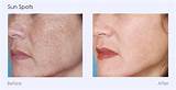 Images of Spider Vein Laser Treatment How Long To See Results