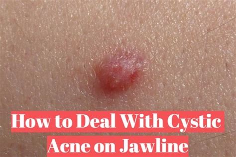 Cystic Acne On Jawline Here Is How You Can Deal With It