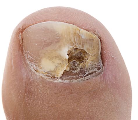 Thick Yellow Toenails Causes Home Remedies And Best Treatments