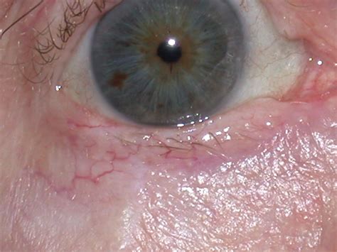 Eyelid Plastic And Reconstructive Surgery Warwar Eye Group