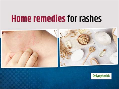 Want To Treat Rashes On Skin Here Are 7 Effective Home Remedies To Get
