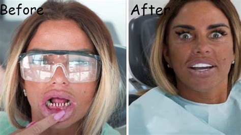 Katie Price Teeth With And Without Veneers