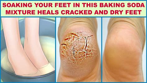 Vinegar foot soaks can also soothe dry, cracked feet. Soak Your Feet In This Baking Soda Mixture 2 Times A Week ...