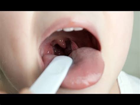 Tonsillectomy Surgery Youtube