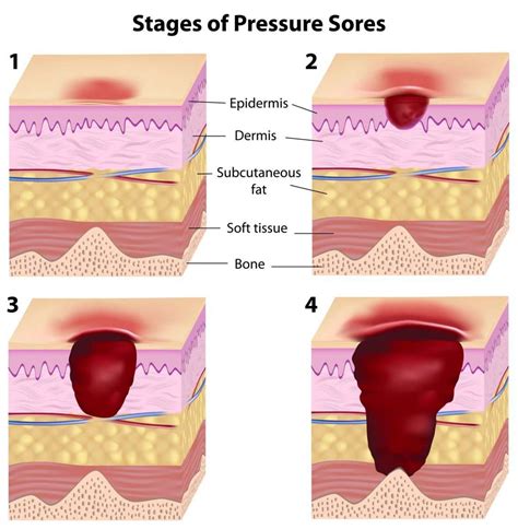 What Are The Stages Of Pressure Ulcers Ulcertalk Hot Sex Picture