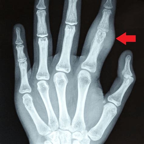 Plain Radiographs Of The Left Hand Postero Anterior View Showing Soft