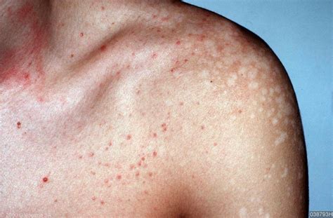 Skin Disease Types Tinea Versicolor