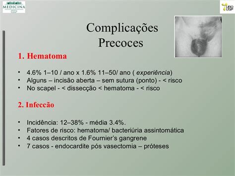 Vasectomia Vantagens E Desvantagens