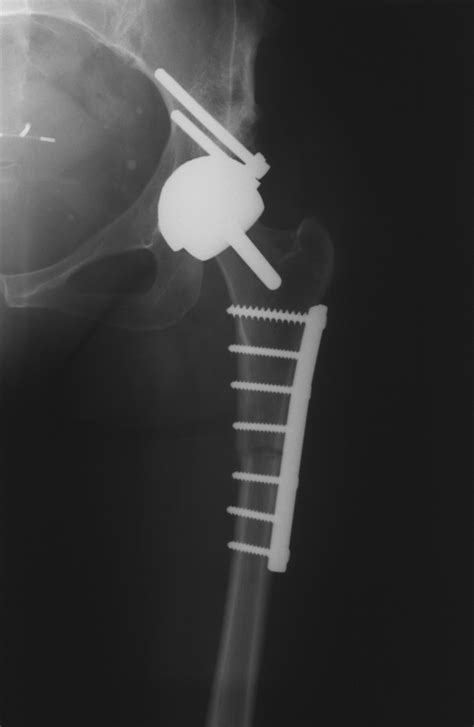 Metal On Metal Hip Resurfacing In Developmental Dysplasia Bone And Joint