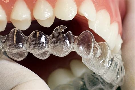 Ortodoncia Invisible Invisalign Clínica Dental Goenea