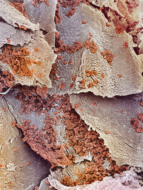 Bacterial Infection Of Nail Sem Stock Image M2700285 Science